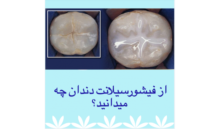 از فیشورسیلانت دندان چه می‌دانید؟